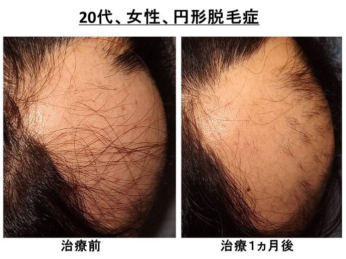 円形脱毛症　病院